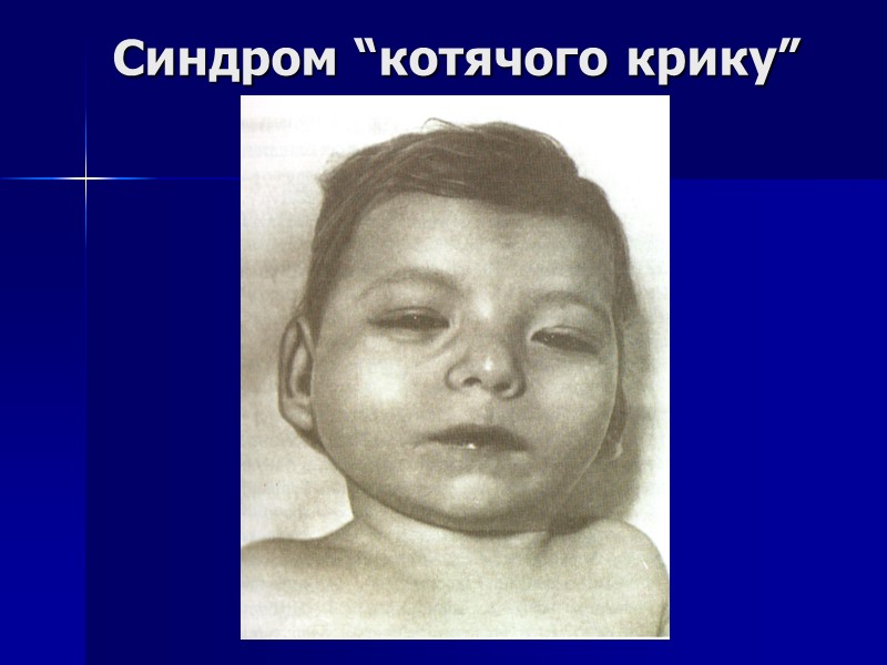 Синдром “котячого крику”